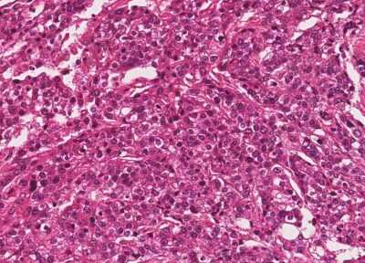 Immunohistochemistry-Paraffin: Human Bladder Tissue MicroArray (Cancer) [NBP3-11846]