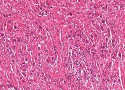 Immunohistochemistry-Paraffin: Human Bladder Tissue MicroArray (Cancer) [NBP3-11846]