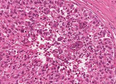Immunohistochemistry-Paraffin: Human Bladder Tissue MicroArray (Cancer) [NBP3-11846]