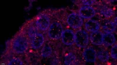 Immunohistochemistry: Human Prostate Tissue MicroArray (Cancer) [NBP2-30169]