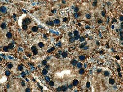 Immunohistochemistry: Human Prostate Tissue MicroArray (Cancer) [NBP2-30169]