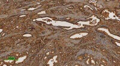 Immunohistochemistry: Human Prostate Tissue MicroArray (Cancer) [NBP2-30169]