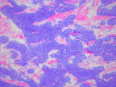 Hematoxylin & Eosin Stain: Human Tissue Slides (Thymoma)- Frozen [NBP2-77649]