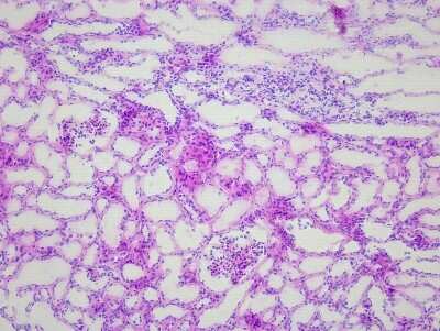 Hematoxylin & Eosin Stain: Kidney Matched Tumor and Normal Tissue Slides (Tumor)- Frozen [NBP2-77671]