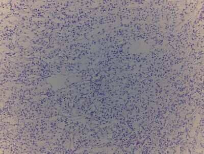 Hematoxylin & Eosin Stain: Kidney Tissue Slides (Tumor)- Frozen [NBP2-77637]