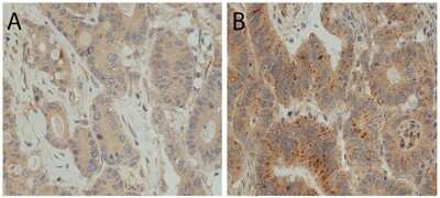 Immunohistochemical Staining of LC3B in CC Tissue with Low and High LC3B Dot Like Staining