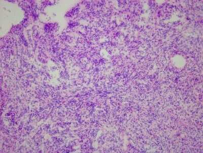Hematoxylin & Eosin Stain: Liver Matched Primary Tumor and Metastatic Tumor Slides - Frozen [NBP2-77665]