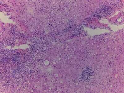 Hematoxylin & Eosin Stain: Liver Matched Tumor and Normal Tissue Slides (Tumor)- Frozen [NBP2-77672]