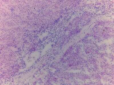 Hematoxylin & Eosin Stain: Liver Tissue Slides (Tumor)- Frozen [NBP2-77638]