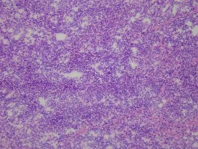 Hematoxylin & Eosin Stain: Lung Matched Primary Tumor and Metastatic Tumor Slides - Frozen [NBP2-77666]