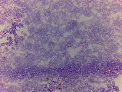 Hematoxylin & Eosin Stain: Lung Tissue Slides (Tumor)- Frozen [NBP2-77639]