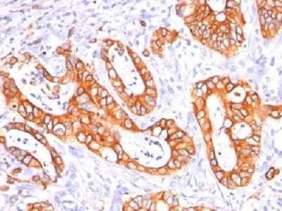 Immunohistochemistry-Paraffin: MUC1 Antibody (GP1.4 + E29) - Azide and BSA Free [NBP2-34624]