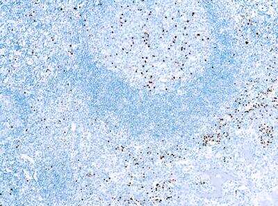 Immunohistochemistry-Paraffin: MUM1 Antibody (MUM1p) [NB200-356]