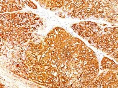 Immunohistochemistry-Paraffin: Melanoma Marker (MART-1 + Tyrosinase + gp100) Antibody (A103 + T311 + HMB45) - Azide and BSA Free [NBP2-34547]