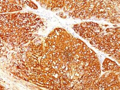 Immunohistochemistry-Paraffin: Melanoma Marker (MART-1 + Tyrosinase + gp100) Antibody (A103 + T311 + HMB45) - IHC-Prediluted [NBP2-48258]