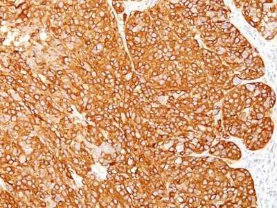 Immunohistochemistry-Paraffin: Melanoma Marker (MART-1 + Tyrosinase + gp100) Antibody (M2-7C10 + M2-9E3 + T311 + HMB45) - Azide and BSA Free [NBP2-34681]