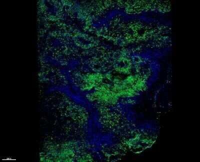 Immunohistochemistry: Melanoma Marker (MART-1 + Tyrosinase + gp100) Antibody (M2-7C10 + M2-9E3 + T311 + HMB45) - IHC-Prediluted [NBP2-48257]