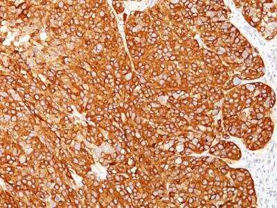 Immunohistochemistry-Paraffin: Melanoma Marker (MART-1 + Tyrosinase + gp100) Antibody (M2-7C10 + M2-9E3 + T311 + HMB45) - IHC-Prediluted [NBP2-48257]