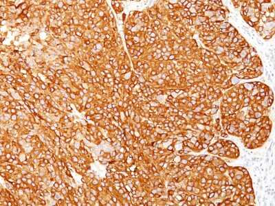 Immunohistochemistry-Paraffin: Melanoma Marker (MART-1 + Tyrosinase + gp100) Antibody (M2-7C10 + M2-9E3 + T311 + HMB45) [NBP2-34337]