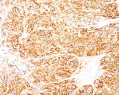 Immunohistochemistry-Paraffin: Melanoma Marker (MART-1 + gp100) Antibody (DT101+ BC199 + HMB45) - Azide and BSA Free [NBP2-34608]