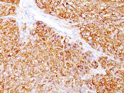 Immunohistochemistry-Paraffin: Melanoma Marker (MART-1 + gp100) Antibody (DT101+ BC199 + HMB45) - IHC-Prediluted [NBP2-48232]