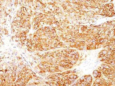 Immunohistochemistry-Paraffin: Melanoma Marker (MART-1 + gp100) Antibody (DT101+ BC199 + HMB45) - IHC-Prediluted [NBP2-48232]