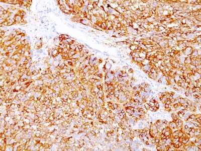 Immunohistochemistry-Paraffin: Melanoma Marker (MART-1 + gp100) Antibody (DT101+ BC199 + HMB45) [NBP2-34341]