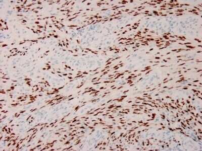 Immunohistochemistry-Paraffin: ORF73/HHV8 Antibody (HHV8/3633R) - Azide and BSA Free [NBP3-08397]