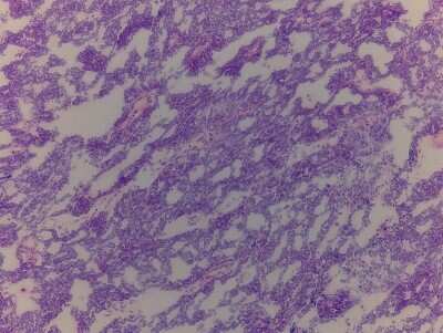 Hematoxylin & Eosin Stain: Ovary Tissue Slides (Tumor)- Frozen [NBP2-77641]