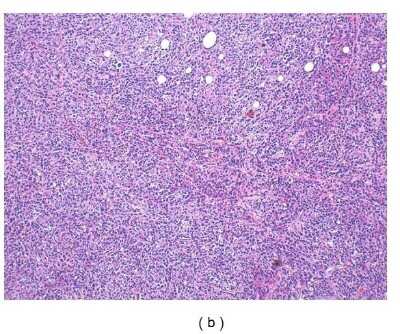 Immunohistochemistry: PD-ECGF/Thymidine Phosphorylase Antibody (PGF 44C) - BSA Free [NB100-2737]