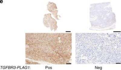 Immunohistochemical Staining of Tumor Sections Using PLAG1 Antibody
