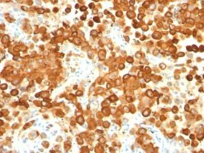 Immunohistochemistry-Paraffin: PMEL17/SILV Antibody (HMB45 + PMEL/783) - Azide and BSA Free [NBP2-47780]