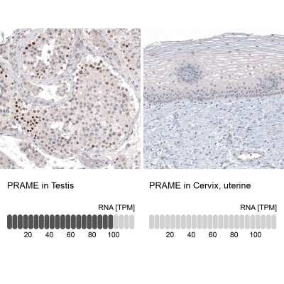 Immunohistochemistry-Paraffin: PRAME Antibody (CL5148) [NBP2-61149]