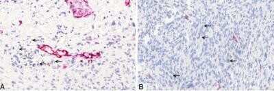 Immunohistochemistry: Podoplanin Antibody (LF3/B7/D5B27) - Azide and BSA Free [NBP2-80915]