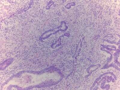 Hematoxylin & Eosin Stain: Rectal Tissue Slides (Tumor)- Frozen [NBP2-77645]