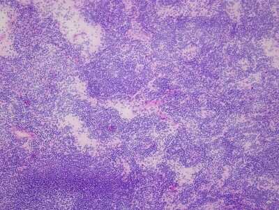 Hematoxylin & Eosin Stain: Rectum Matched Primary Tumor and Metastatic Tumor Slides - Frozen [NBP2-77667]
