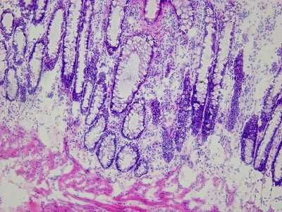 Hematoxylin & Eosin Stain: Rectum Matched Tumor and Normal Tissue Slides (Tumor)- Frozen [NBP2-77674]