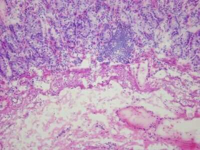 Hematoxylin & Eosin Stain: Stomach Matched Primary Tumor and Metastatic Tumor Slides - Frozen [NBP2-77668]