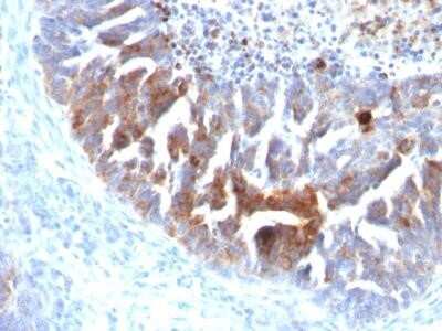 Immunohistochemistry-Paraffin: TAG-72 Antibody (B72.3 + CC49) - IHC-Prediluted [NBP2-45179]