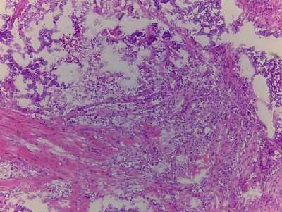 Hematoxylin & Eosin Stain: Testis Tissue Slides (Tumor)- Frozen [NBP2-77648]