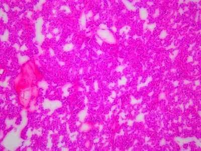 Hematoxylin & Eosin Stain: Thyroid Tissue Slides (Tumor)- Frozen [NBP2-77650]