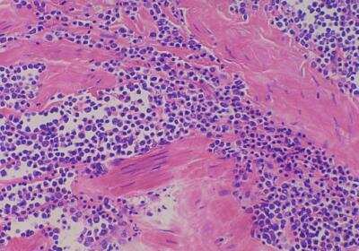 Immunohistochemistry-Paraffin: Uterus Tissue Slides (Sarcoma)- Paraffin [NBP3-11845]