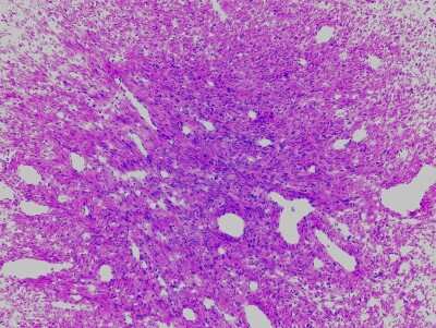 Hematoxylin & Eosin Stain: Uterus Tissue Slides (Tumor)- Frozen [NBP2-77651]