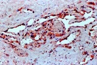 Immunohistochemical Analysis of VEGF in Paraffin Embedded Human Angiosarcoma Tissue