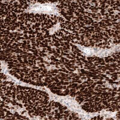 Immunohistochemistry-Paraffin: WT1 Antibody (CL13165) [NBP3-18564]