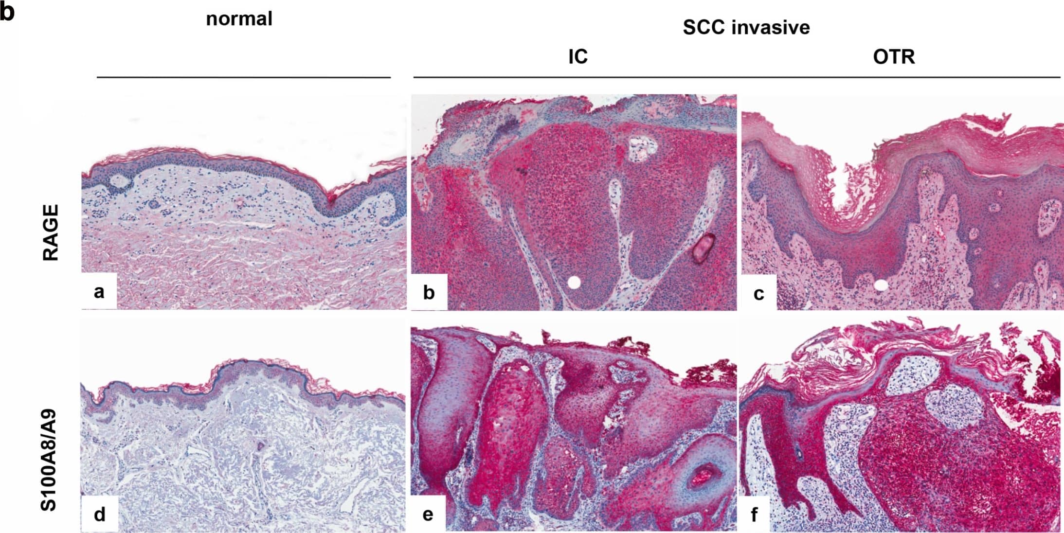 Detection of Human AGER by Immunohistochemistry