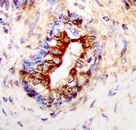 IL-13 Ra2 antibody in Human Prostate Cancer Tissue by Immunohistochemistry (IHC-P).