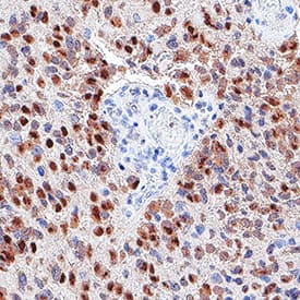 Detection of SOX2 in glioblastoma.