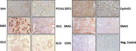 Detection of Human Snail by Immunohistochemistry