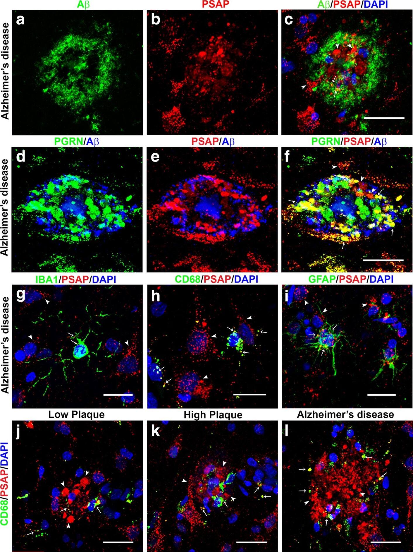 Detection of Human PSAP by Immunocytochemistry/Immunofluorescence